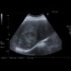 Hepatocellular adenoma, bleeding after biopsy: US - Ultrasound
